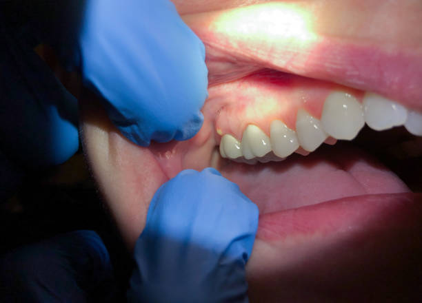 Best Dentist for Tooth Abscess  in Dexter, NM